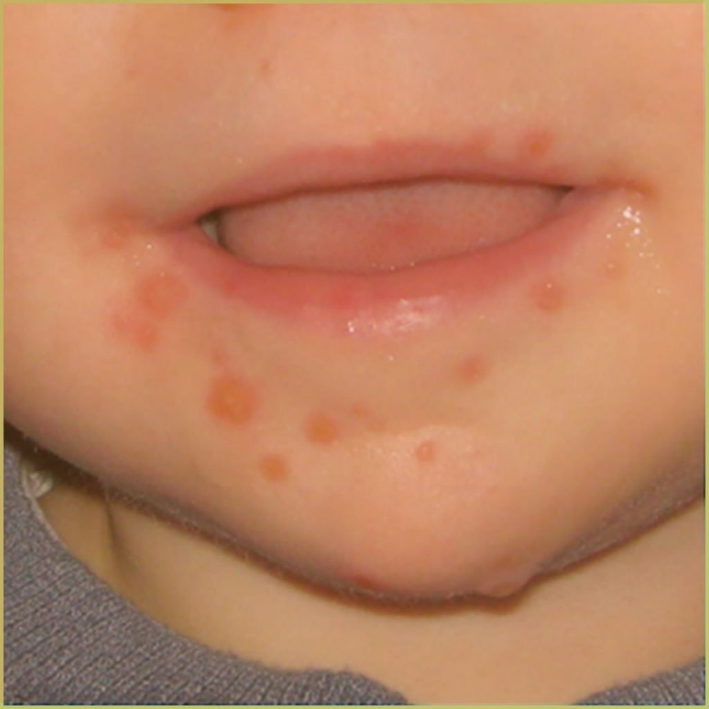 Hand Foot and Mouth Disease 3 1024x1024 1
