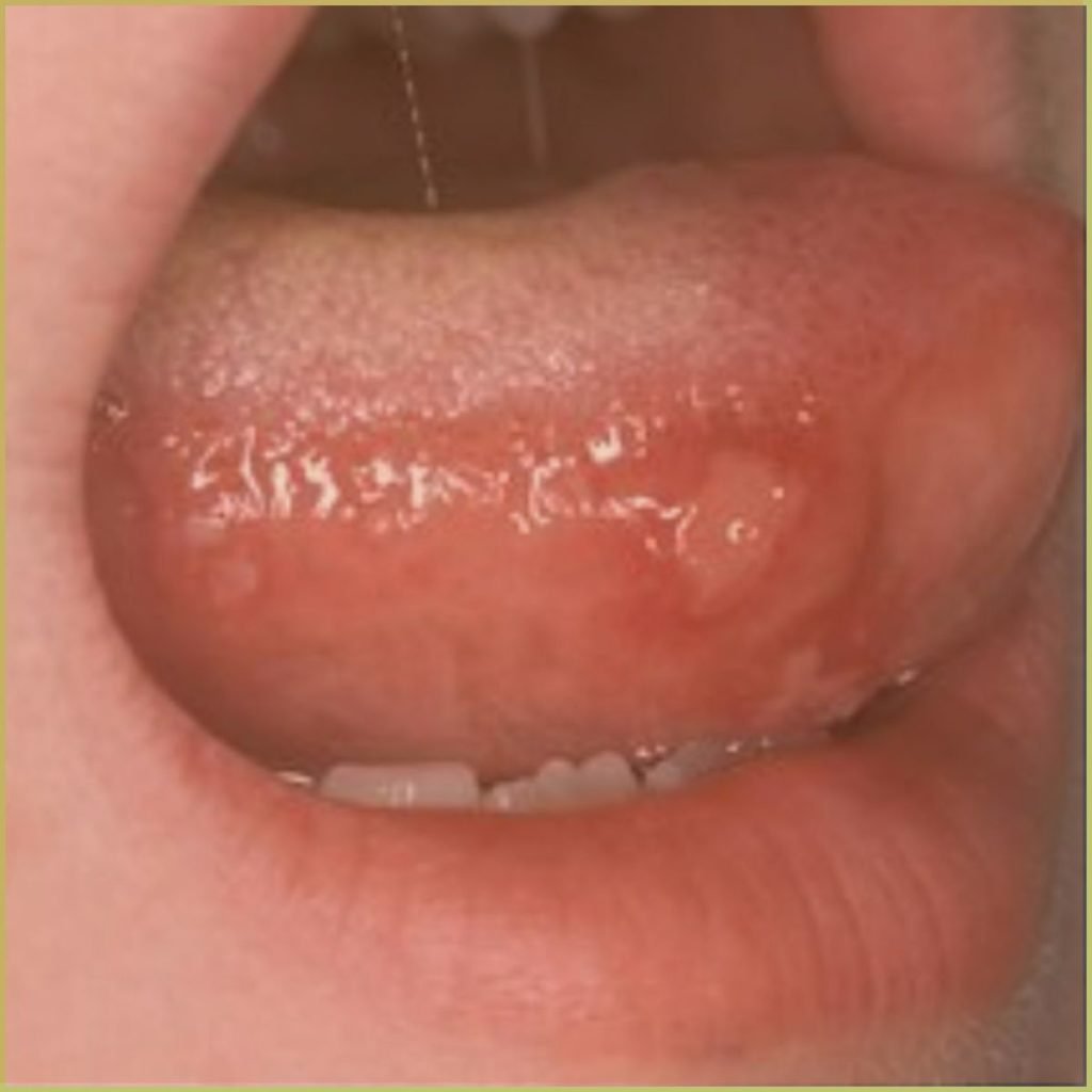 Hand Foot and Mouth Disease 4 1024x1024 1