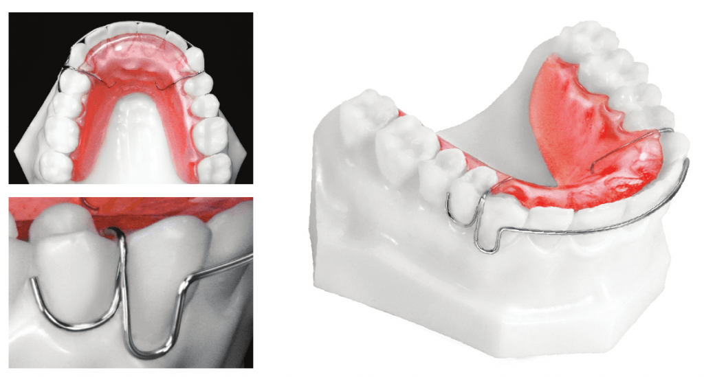 Hawley retainer 1 1024x549 1