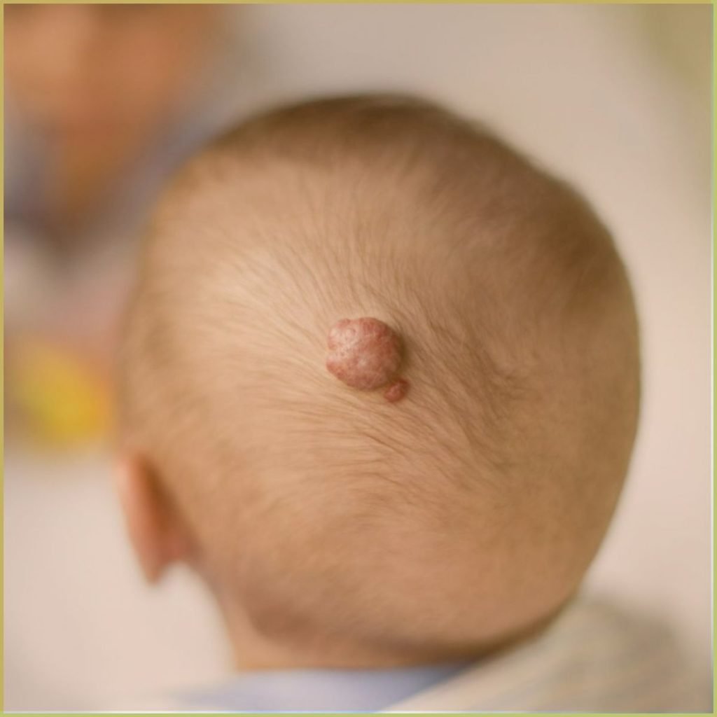 Hemangiomas 2 1024x1024 1