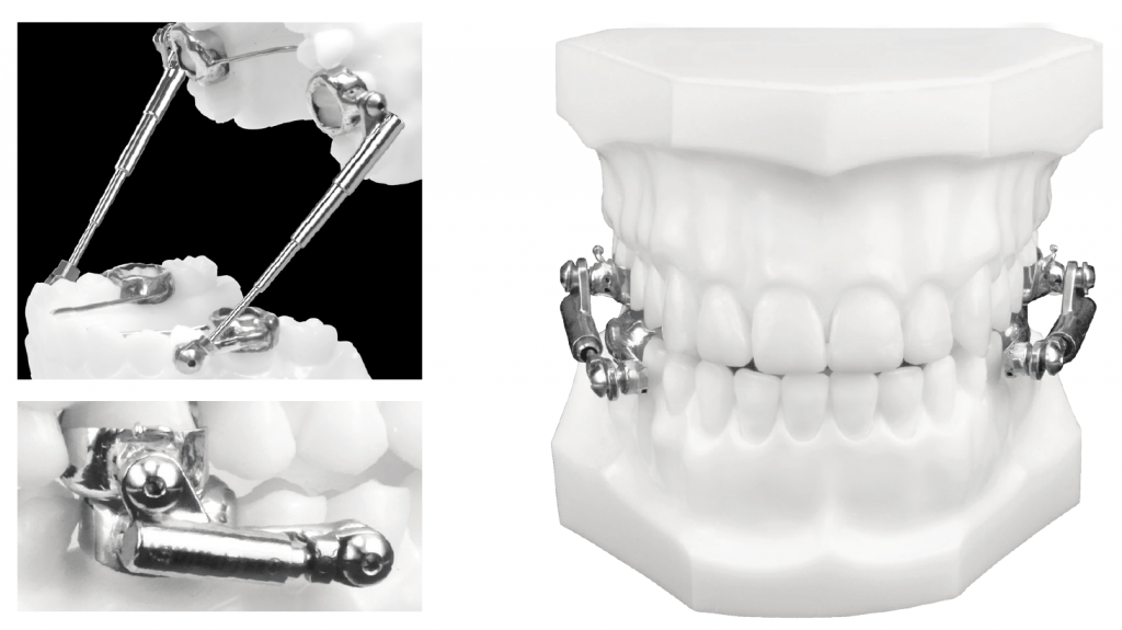 Herbst appliance 1024x575 1