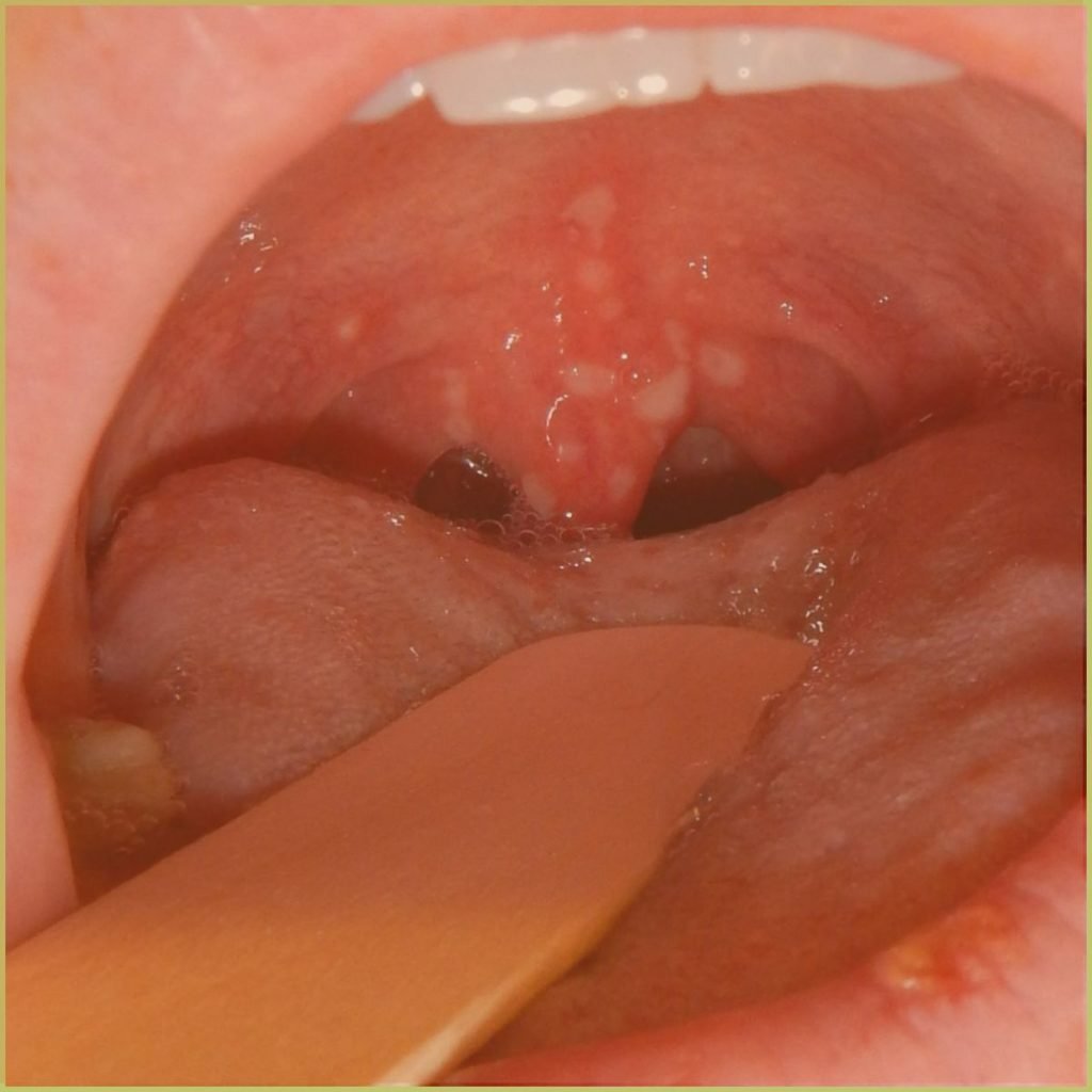 Herpangina 1 1024x1024 1