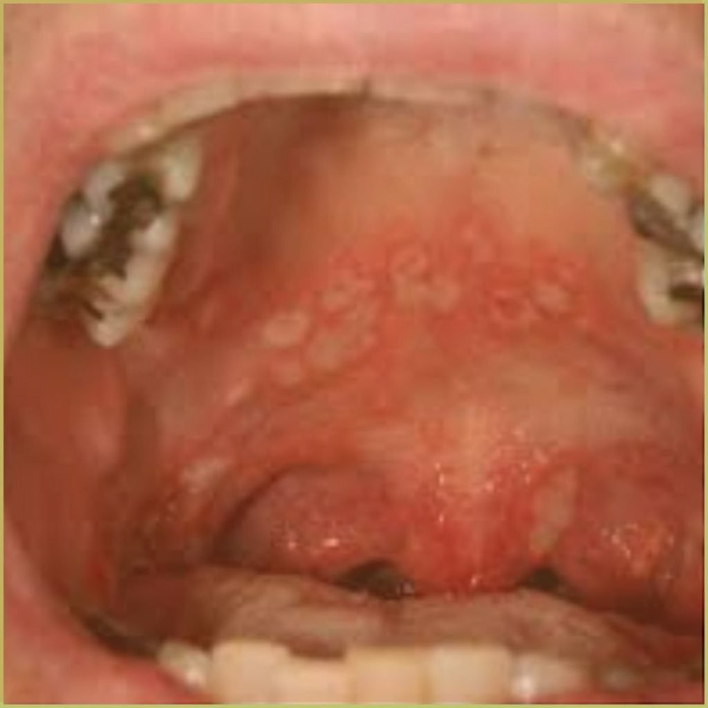 Herpangina 3 1024x1024 1