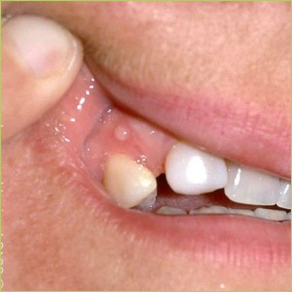 Herpes zoster 1 1 1024x1024 1