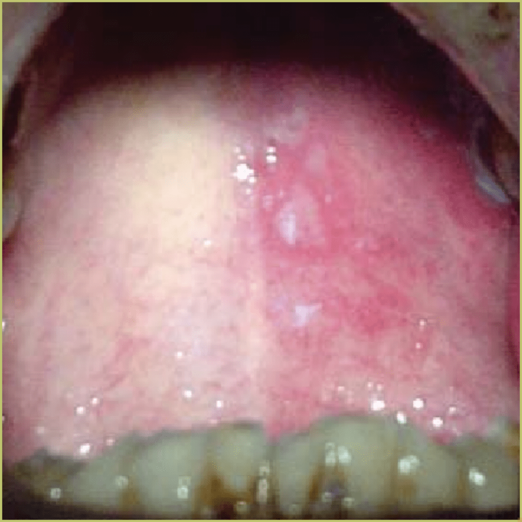 Herpes zoster 3 1 1024x1024 1