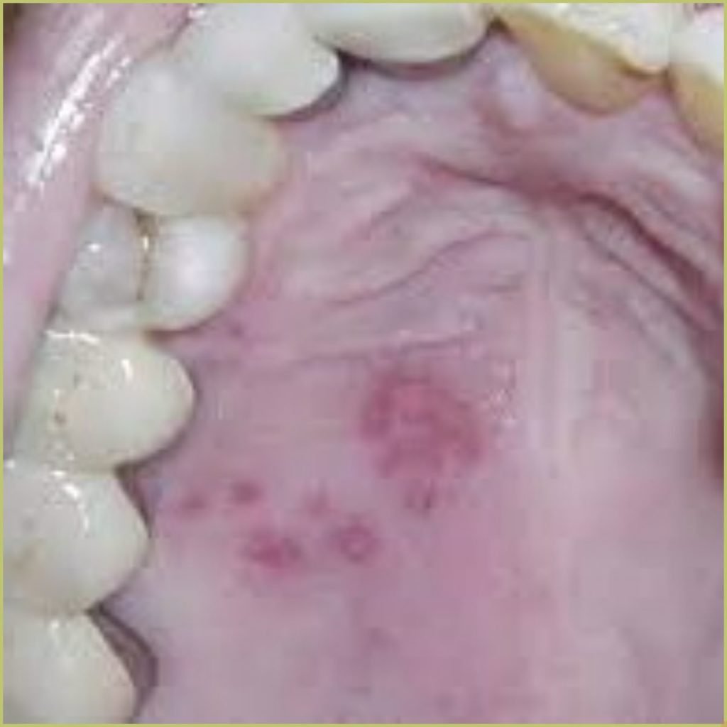 Herpes zoster 4 1 1024x1024 1