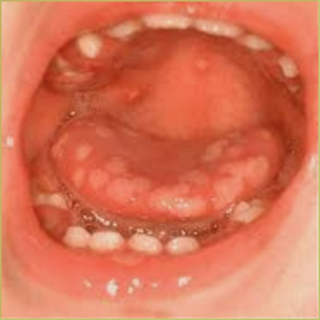 Herpetic gingivostomatitis 1 1024x1024 1