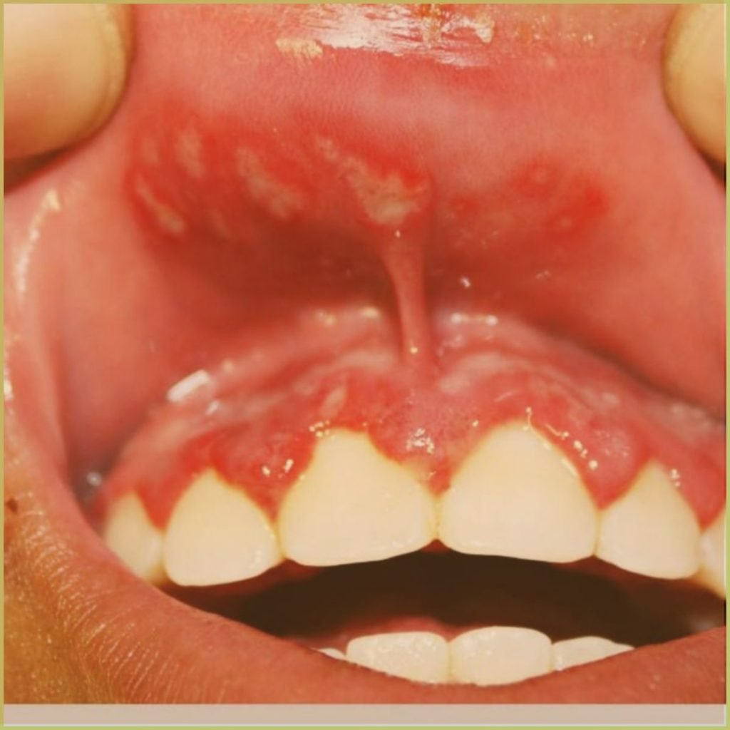 Herpetic gingivostomatitis 4 1024x1024 1