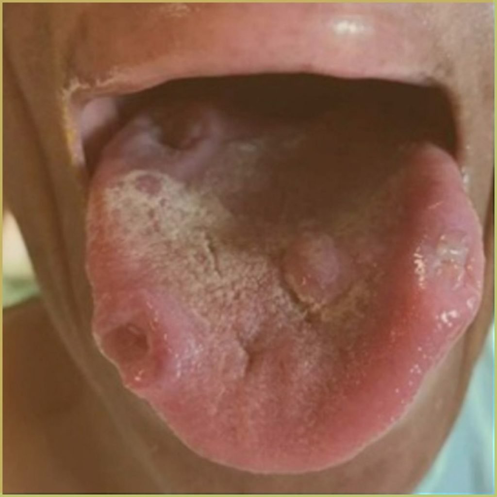 Histoplasmosis 1 1024x1024 1