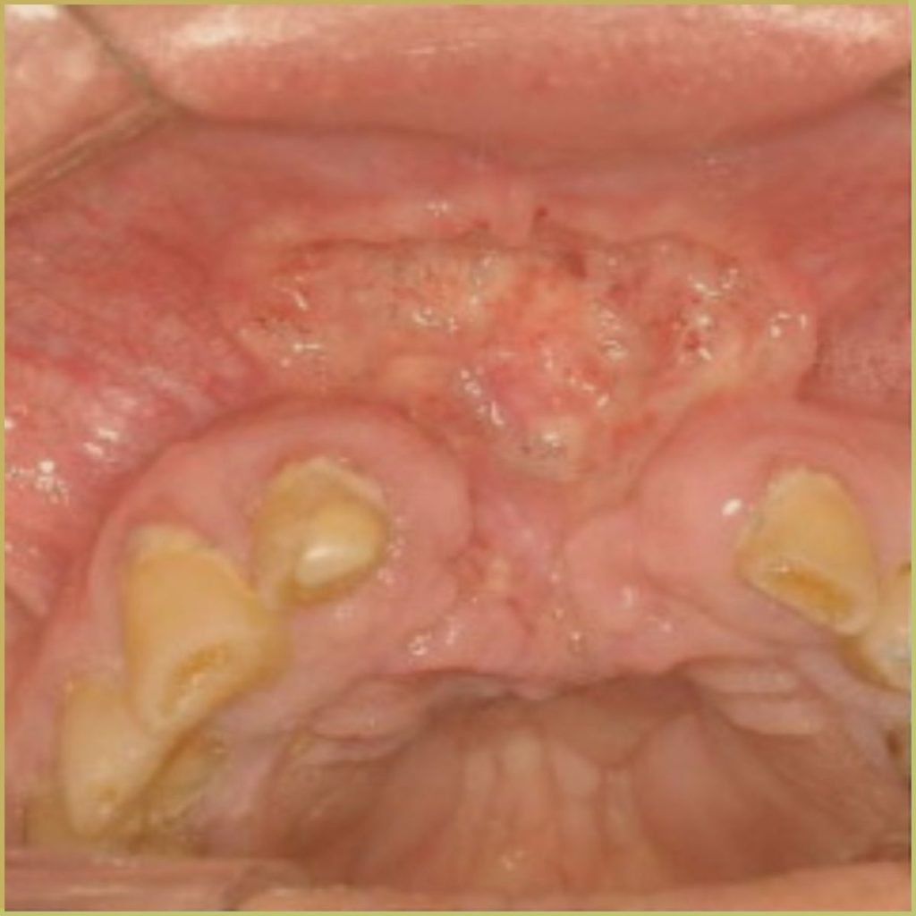 Histoplasmosis 2 1024x1024 1