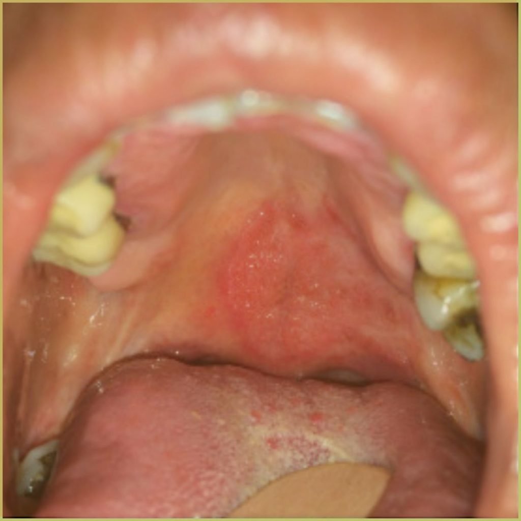 Histoplasmosis 4 1024x1024 1