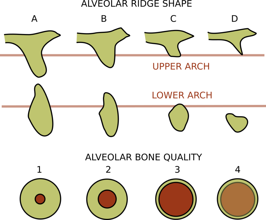 Implant bone quality classification 1024x849 1