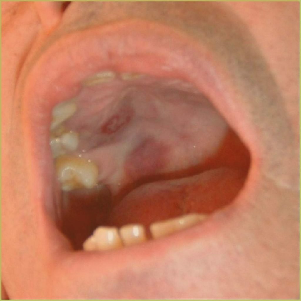 Kaposis Sarcoma 1 1024x1024 1