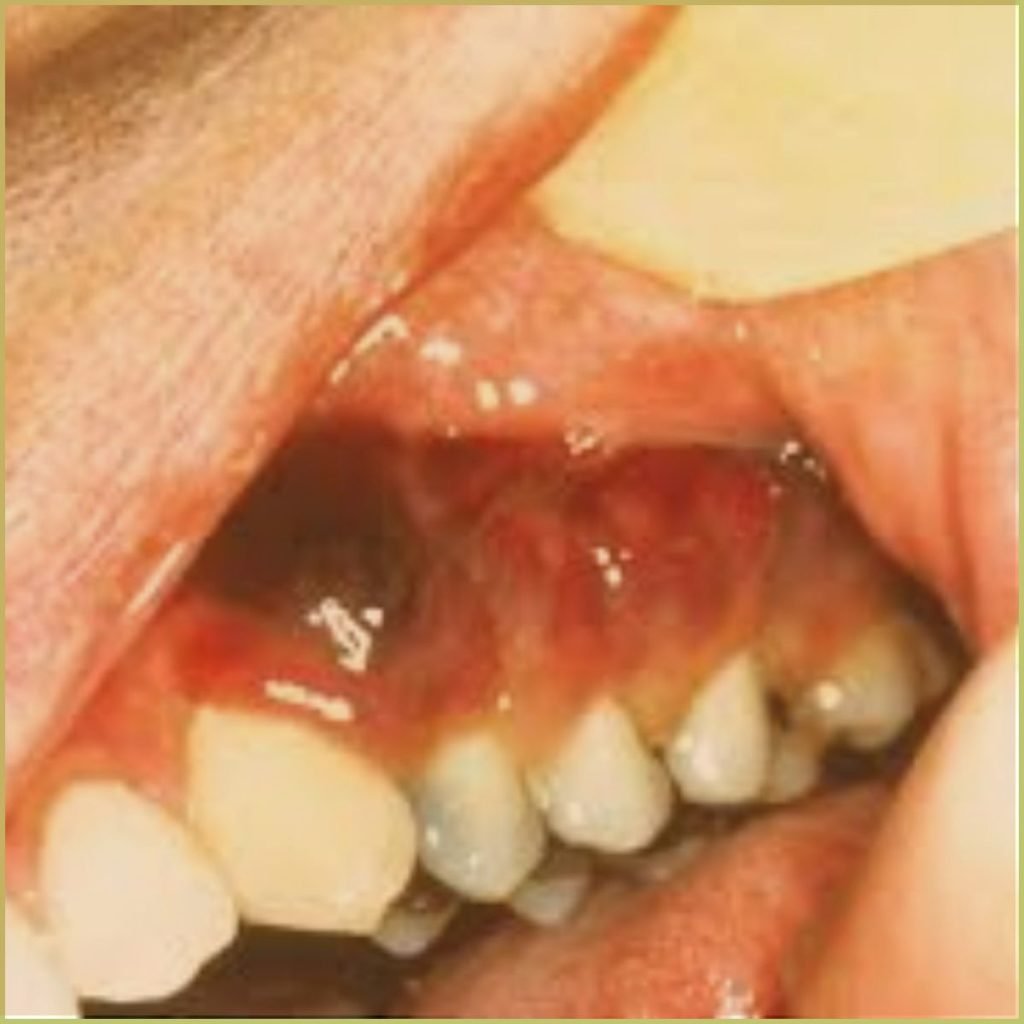 Kaposis Sarcoma 2 1024x1024 1