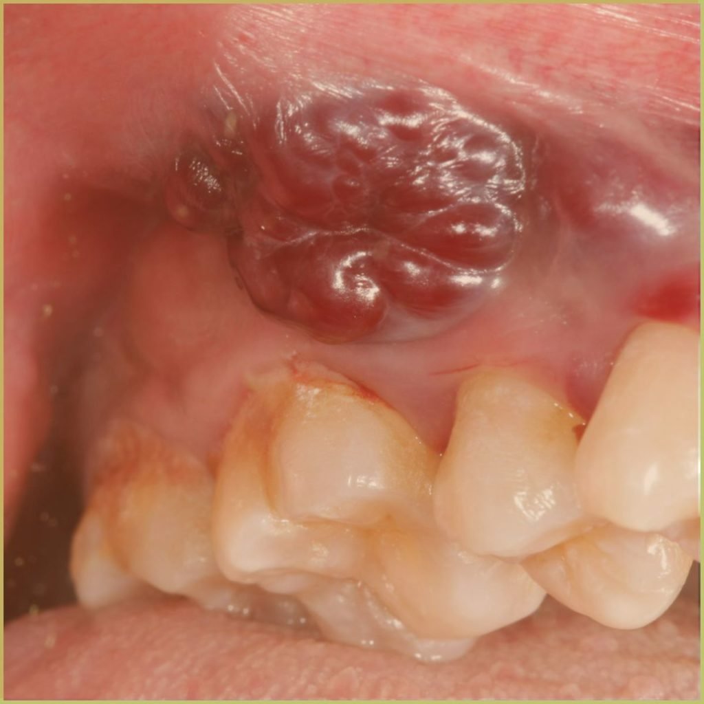 Kaposis Sarcoma 3 1024x1024 1