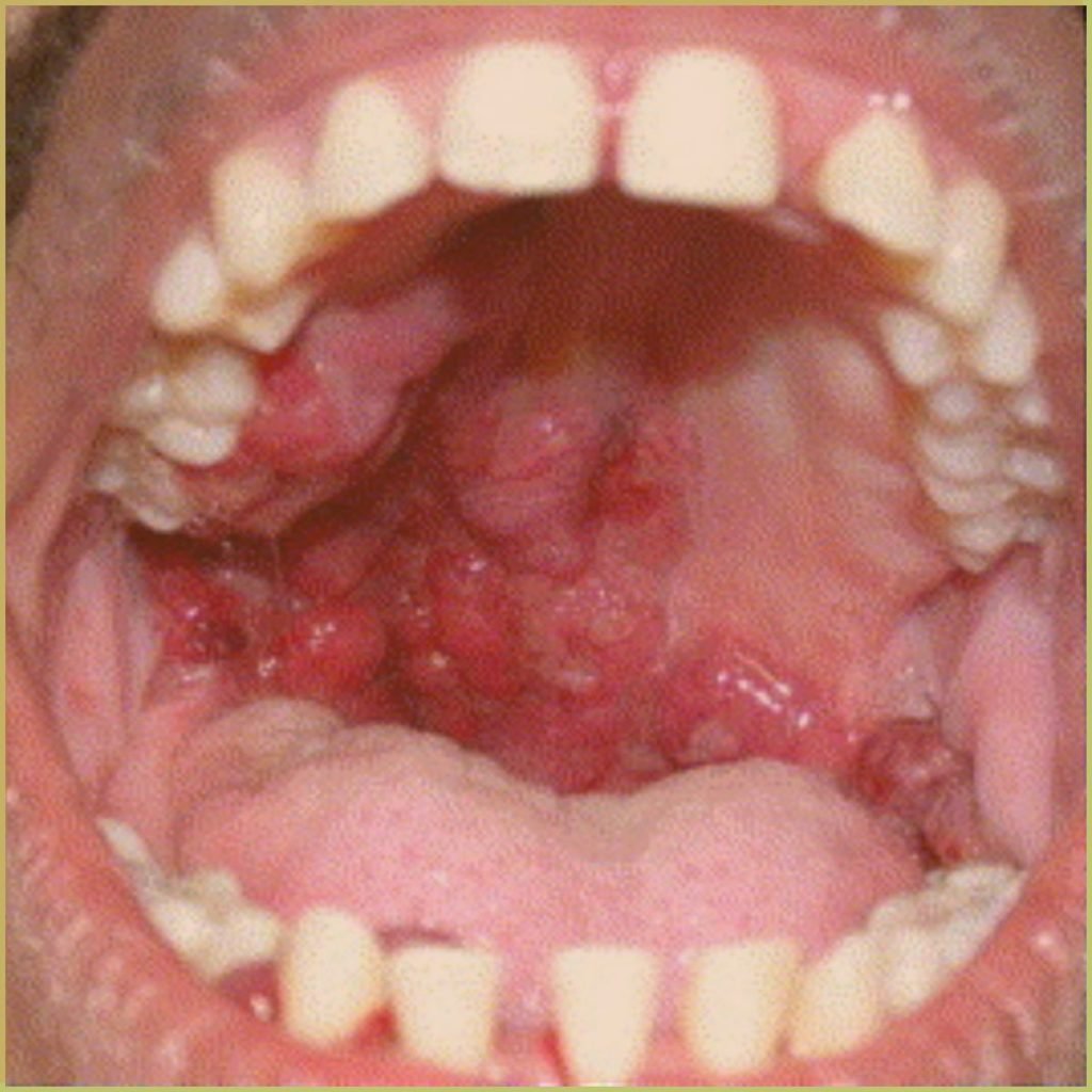 Kaposis Sarcoma 4 1024x1024 1