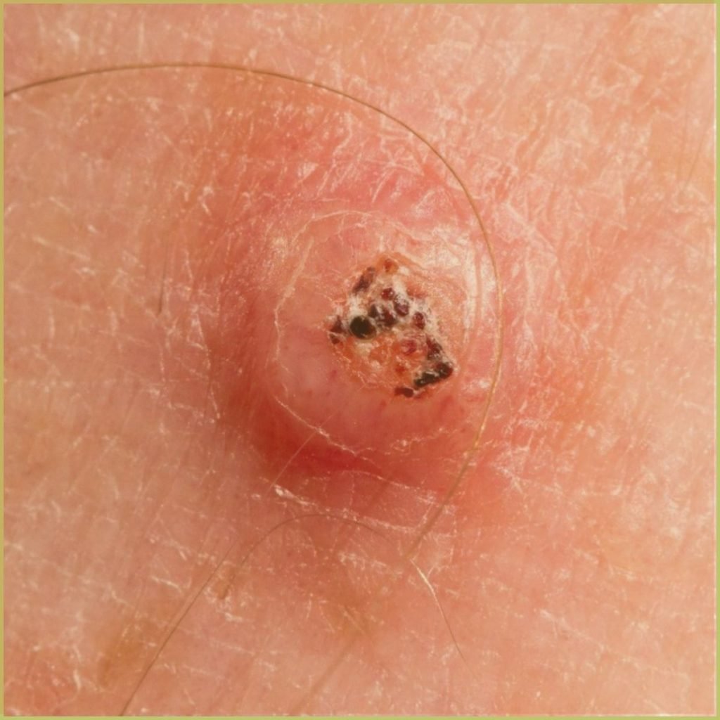 Keratoacanthoma 1 1024x1024 1