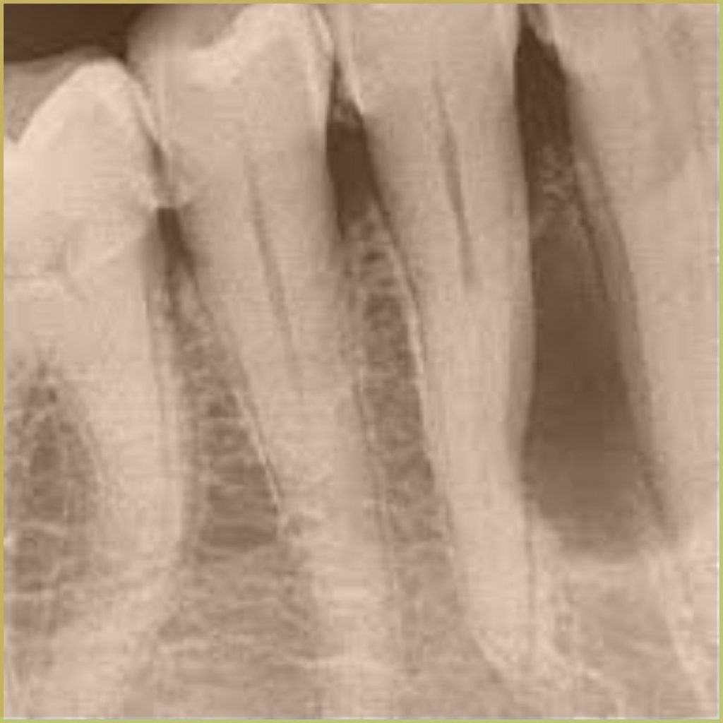 Lateral Periodontal Cyst 1 1024x1024 1
