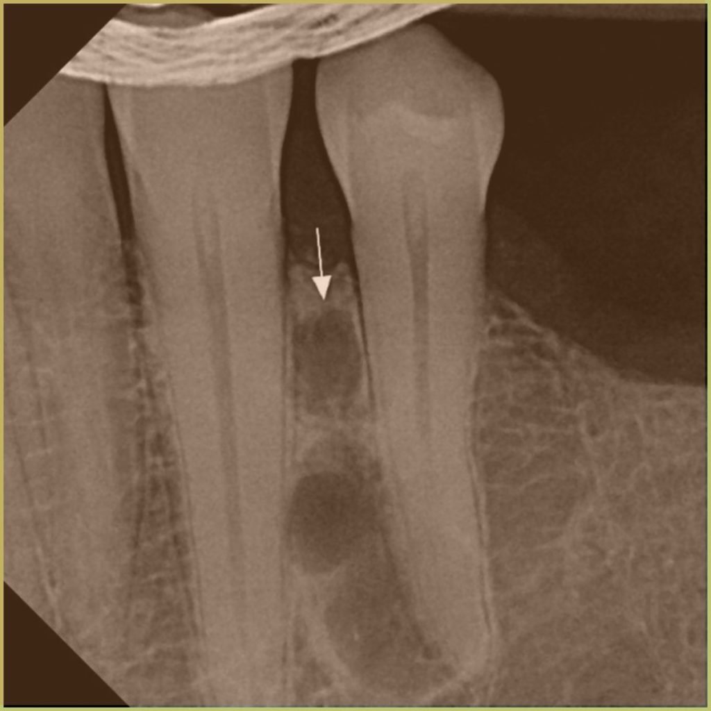 Lateral Periodontal Cyst 3 1024x1024 1
