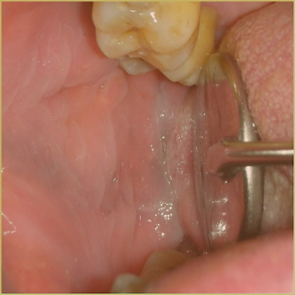 Leukoedema 1 1024x1024 1