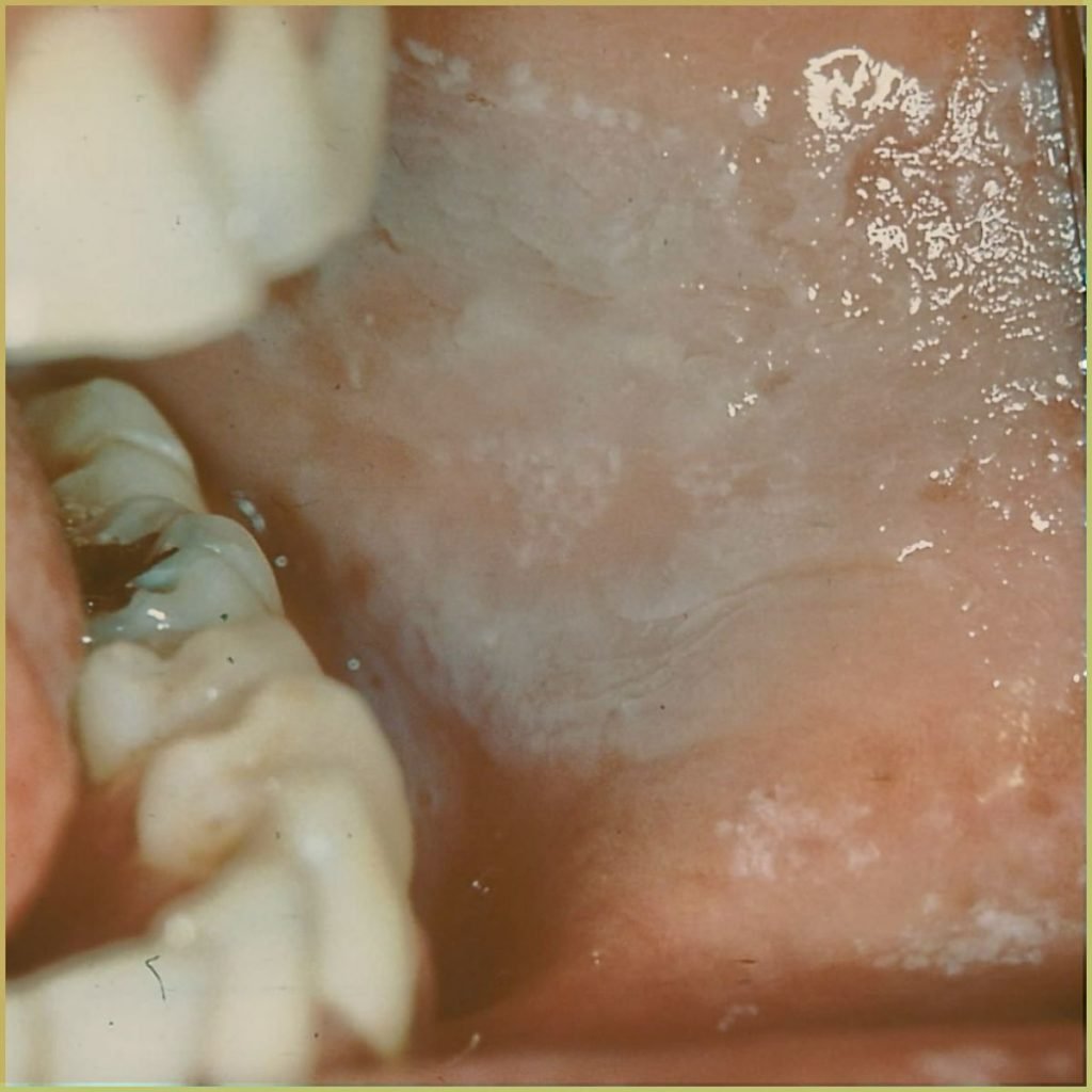 Leukoedema 2 1024x1024 1