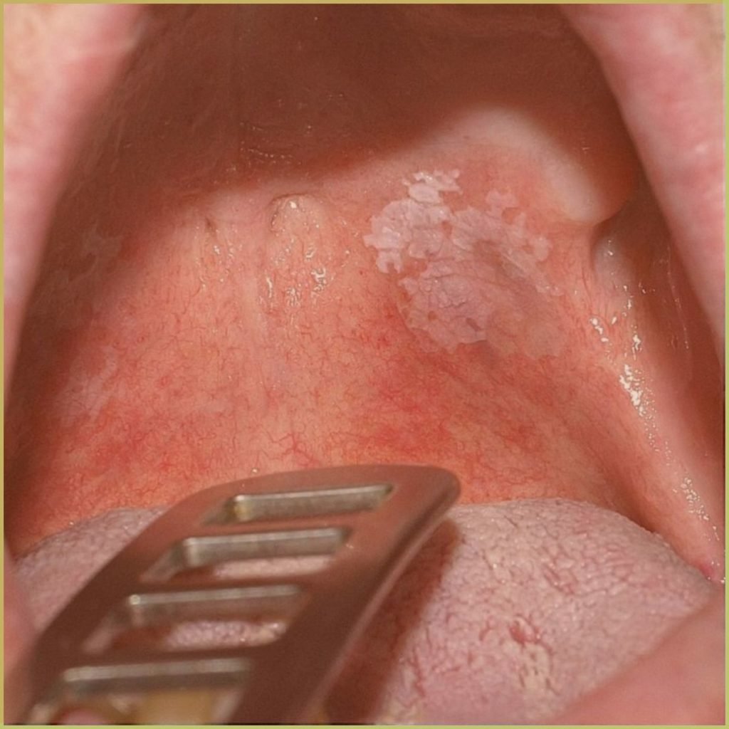 Leukoplakia 1 1024x1024 1