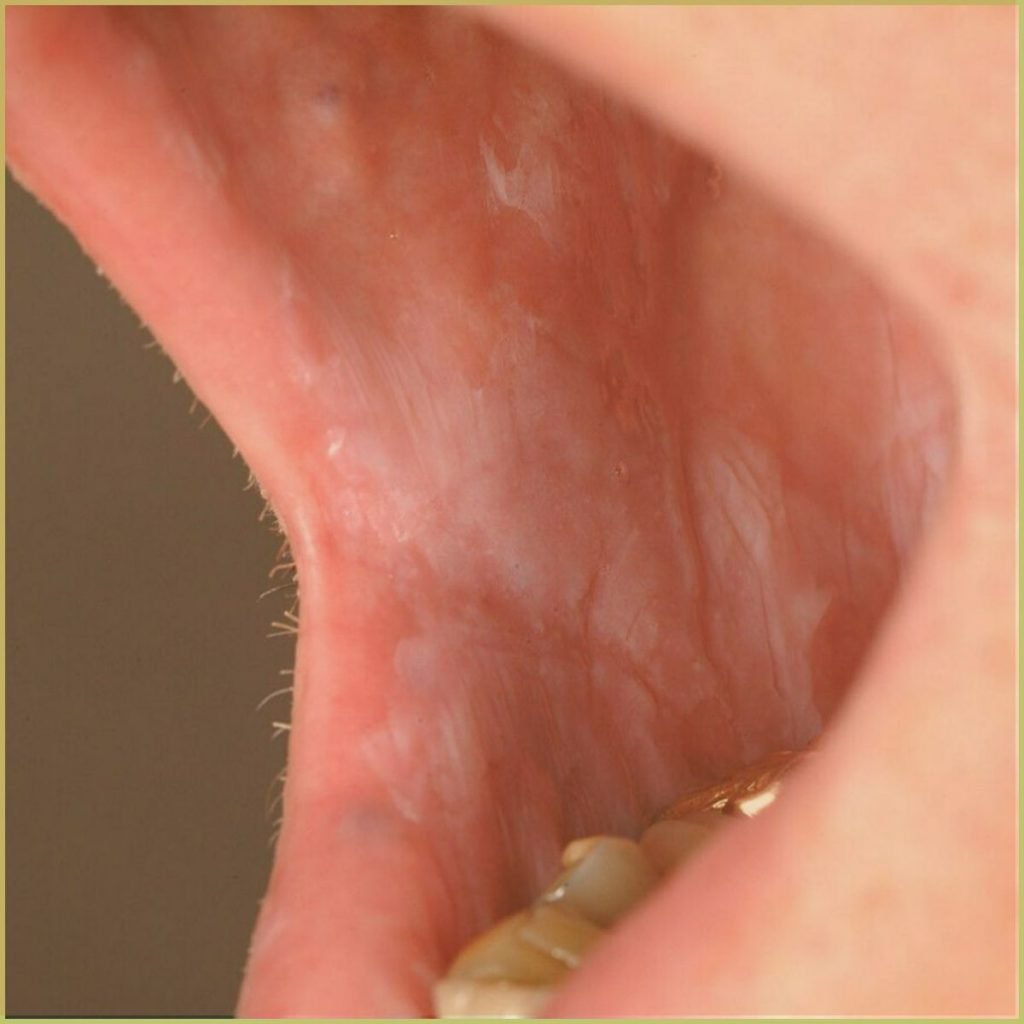 Leukoplakia 2 1024x1024 1