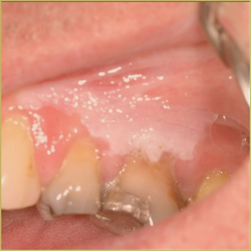 Leukoplakia 3 1024x1024 1
