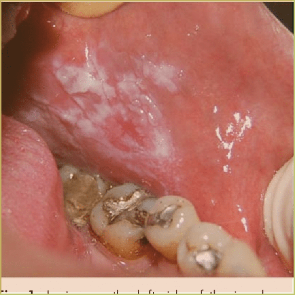 Leukoplakia 4 1024x1024 1