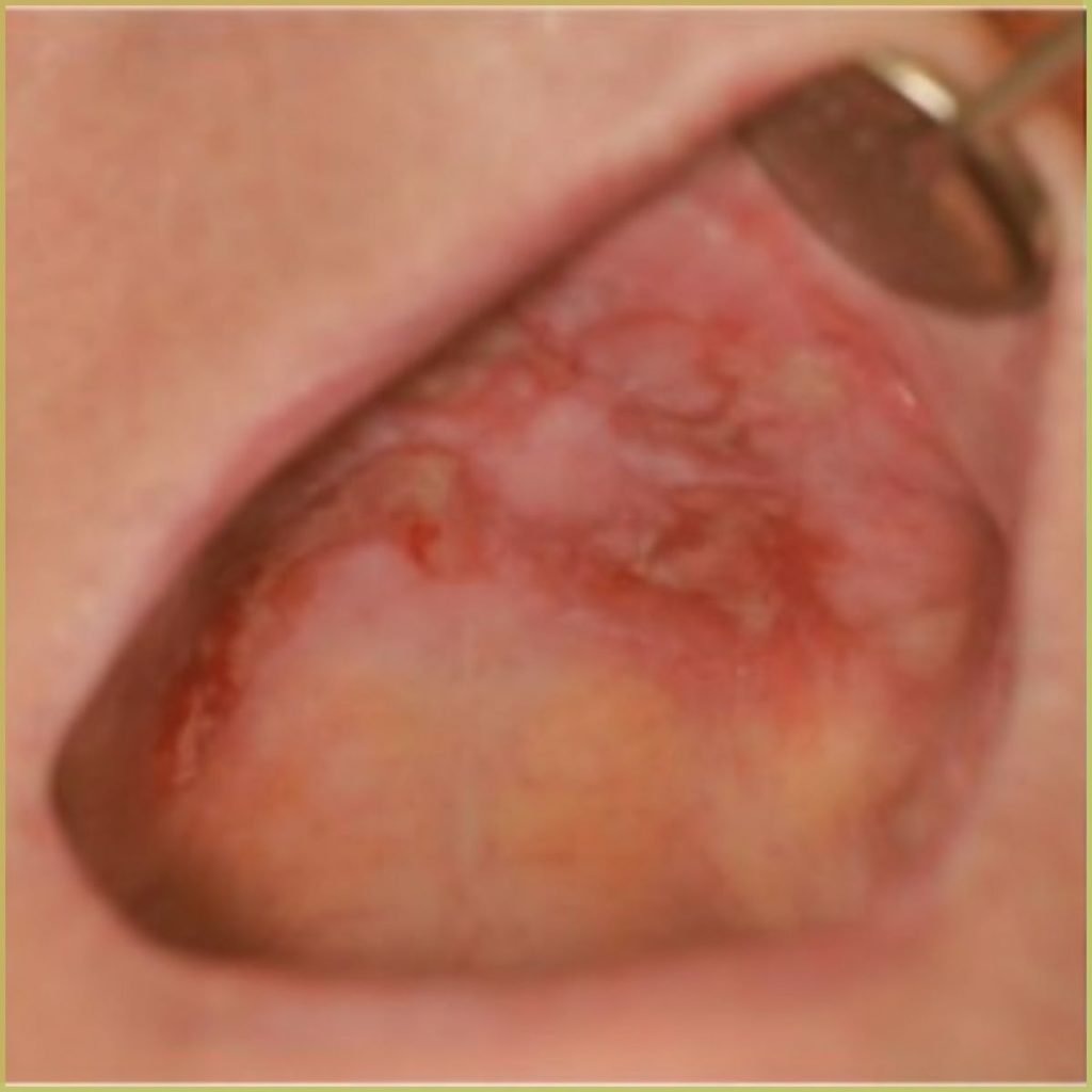 Lichen planus erosive 2 1024x1024 1