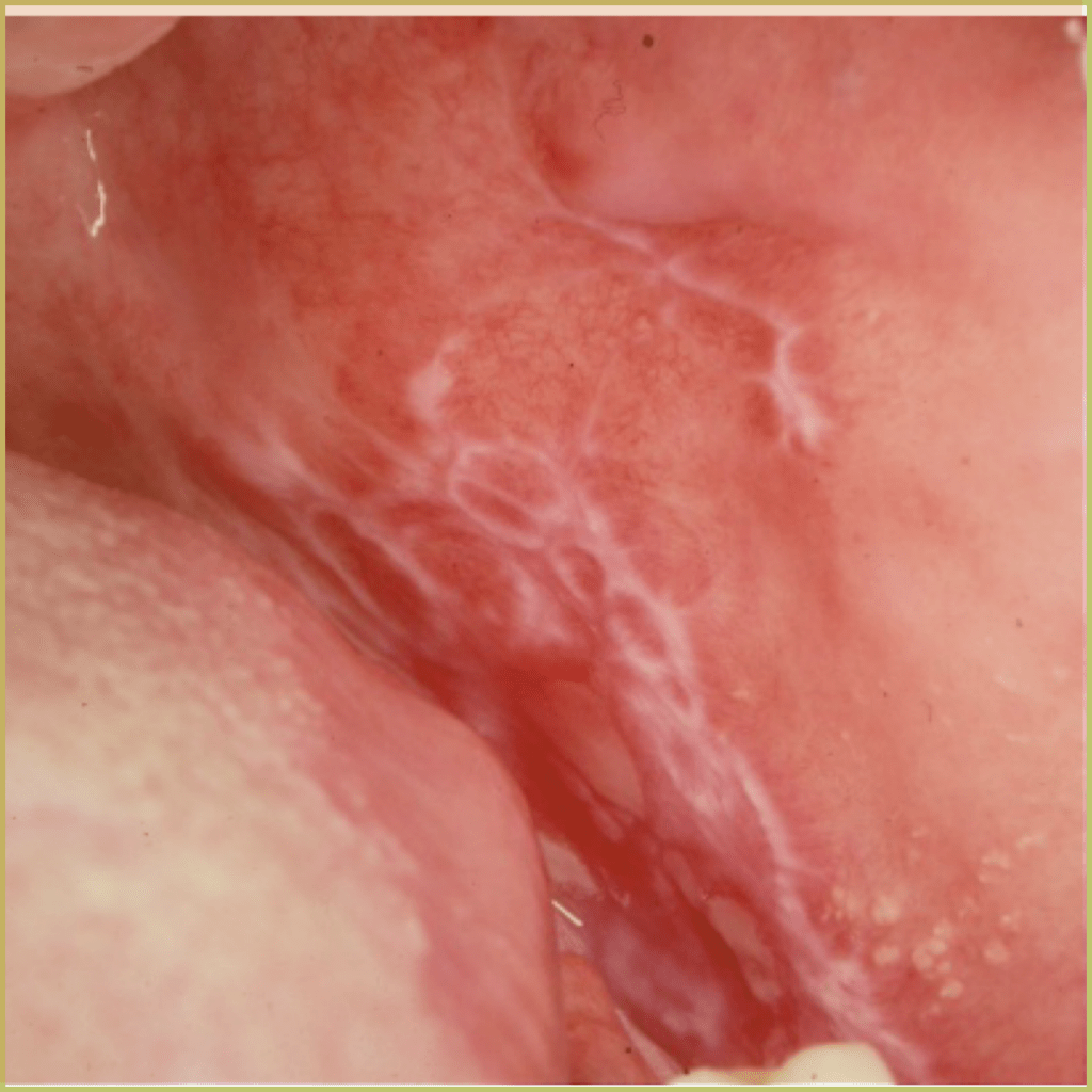 Lichen planus reticular 1 1024x1024 1