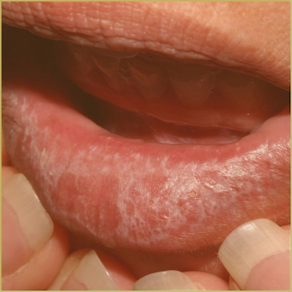 Lichen planus reticular 2 1024x1024 1