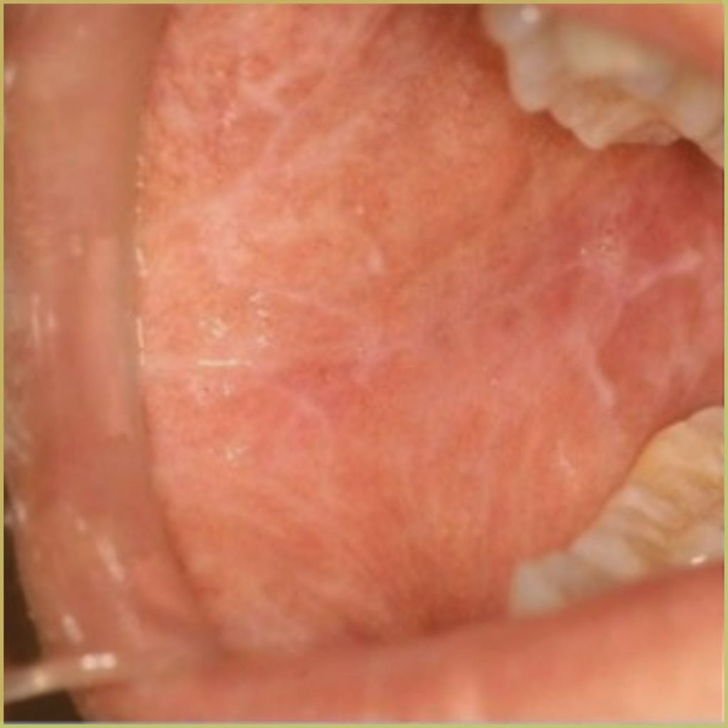 Lichen planus reticular 3 1024x1024 1