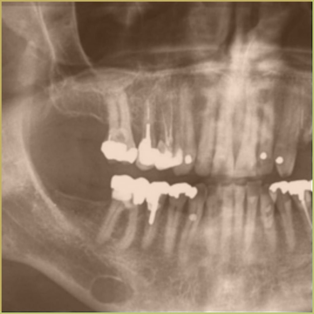 Lingual Bone Defect 1 1024x1024 1