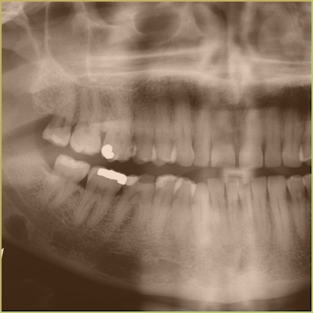Lingual Bone Defect 2 1024x1024 1