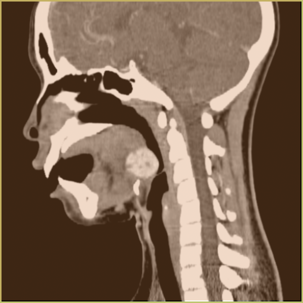 Lingual Thyroid 4 1024x1024 1