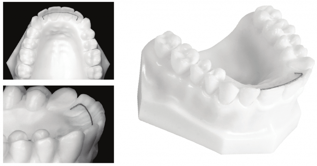 Lingual wire 1024x537 2