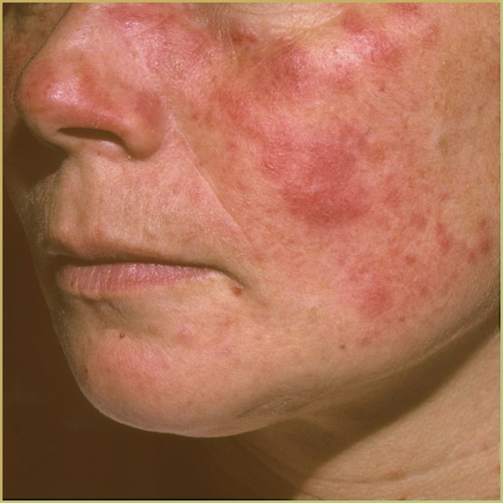 Lupus Erythematosus 1 1024x1024 1