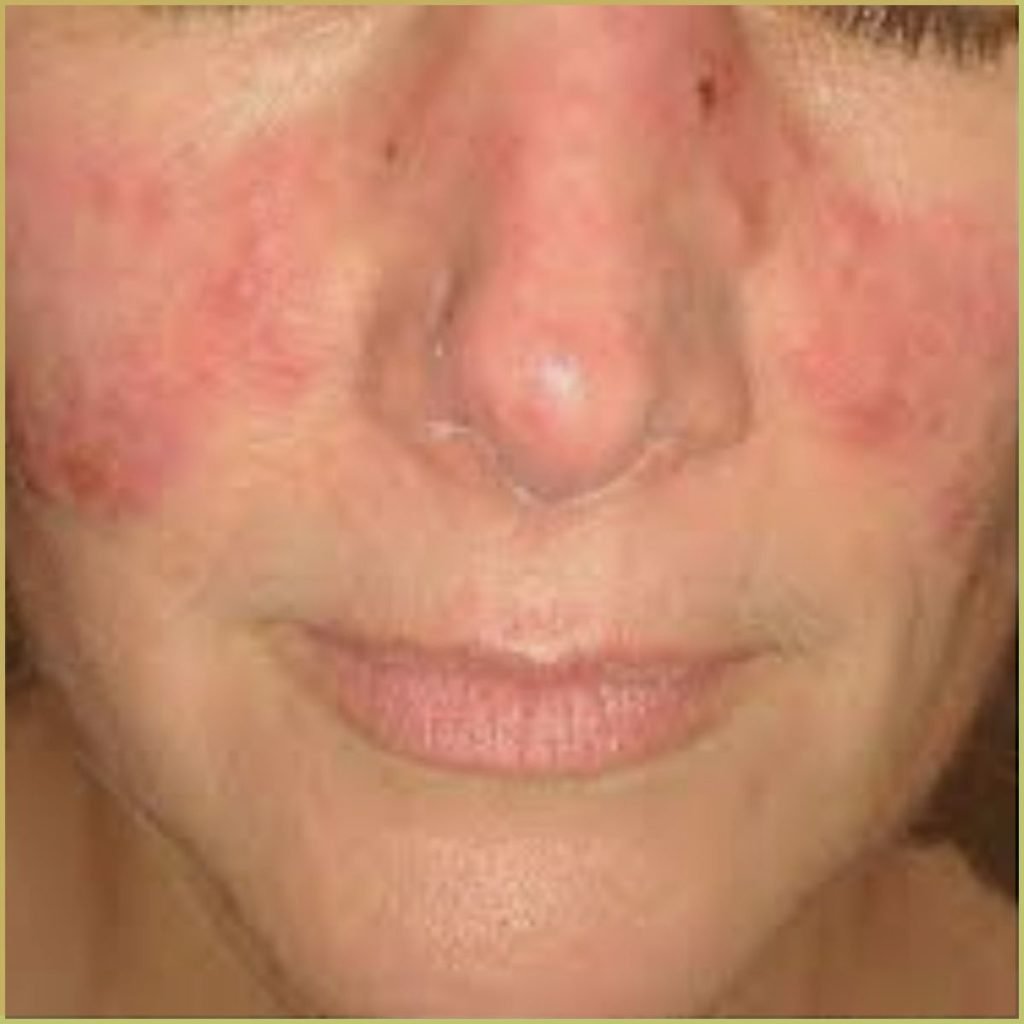 Lupus Erythematosus 2 1024x1024 1