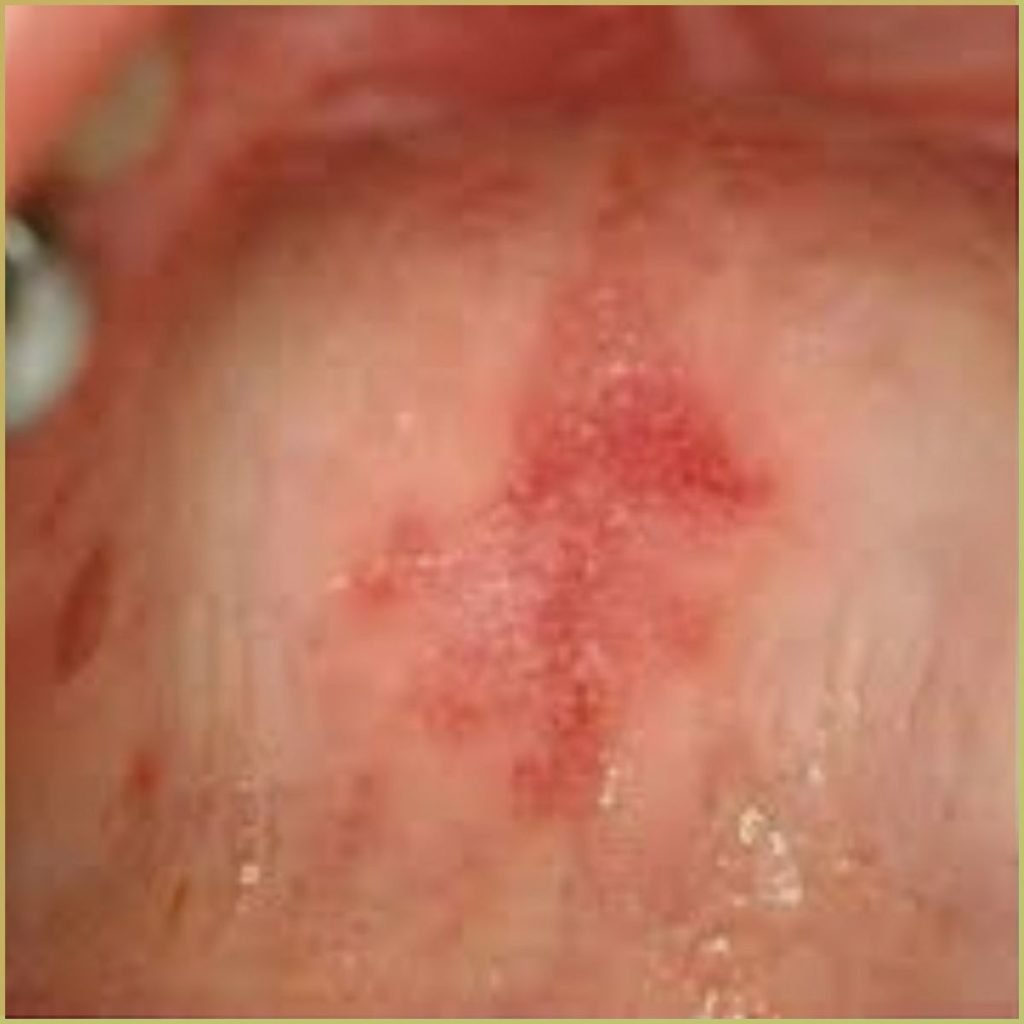 Lupus Erythematosus 3 1024x1024 1