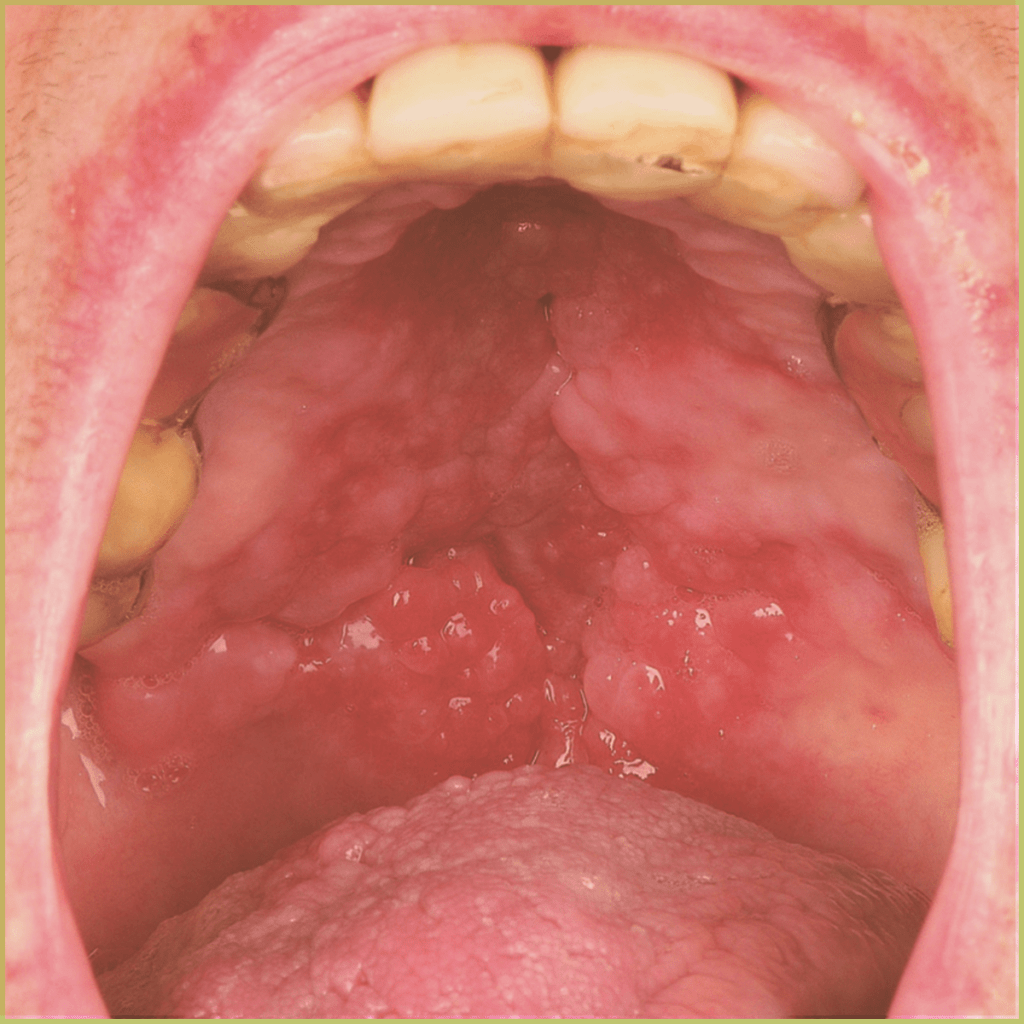 Lupus Erythematosus 5 1024x1024 1