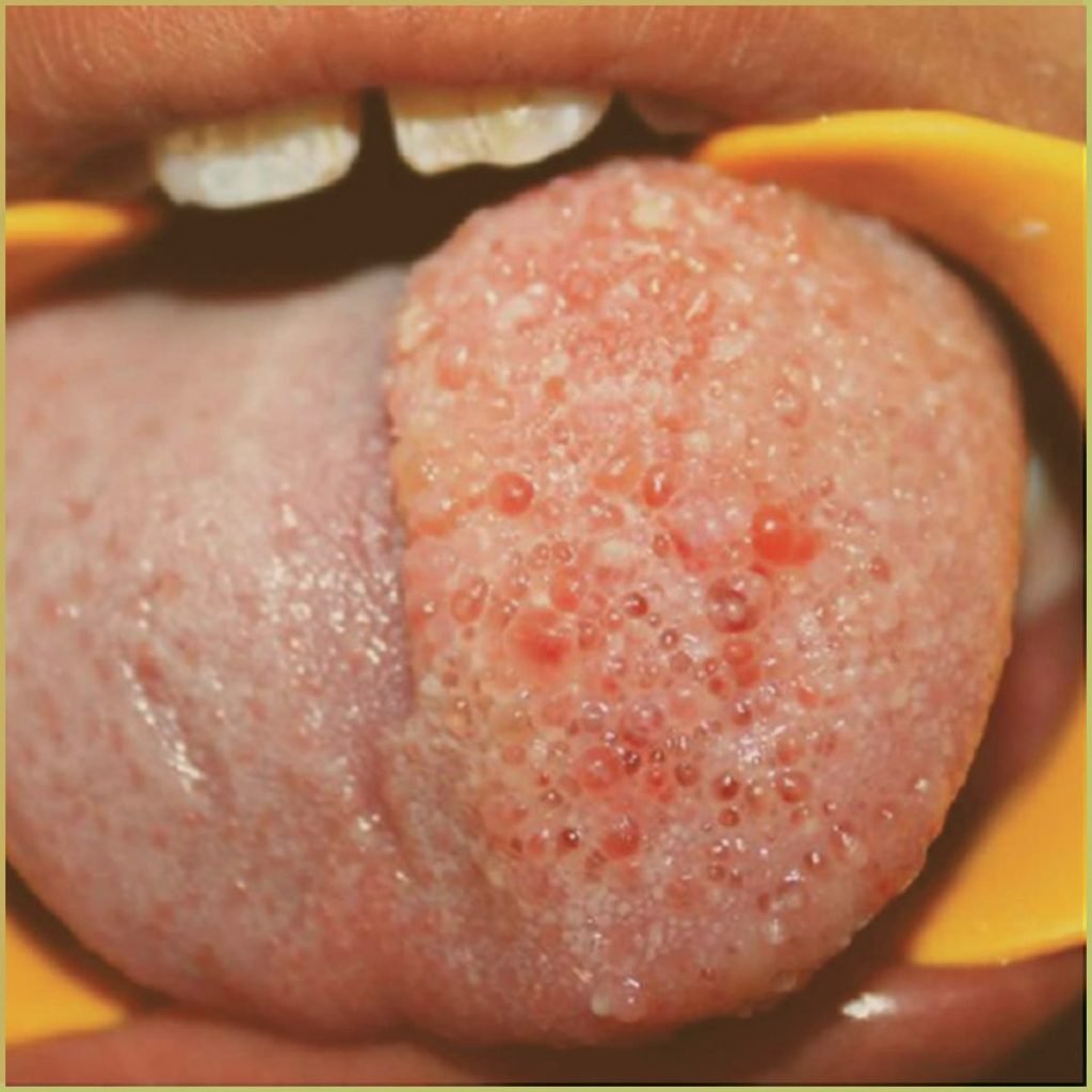 Lymphangioma 1 1024x1024 1