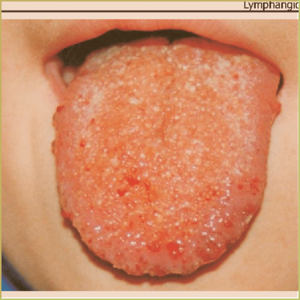 Lymphangioma 2 1024x1024 1