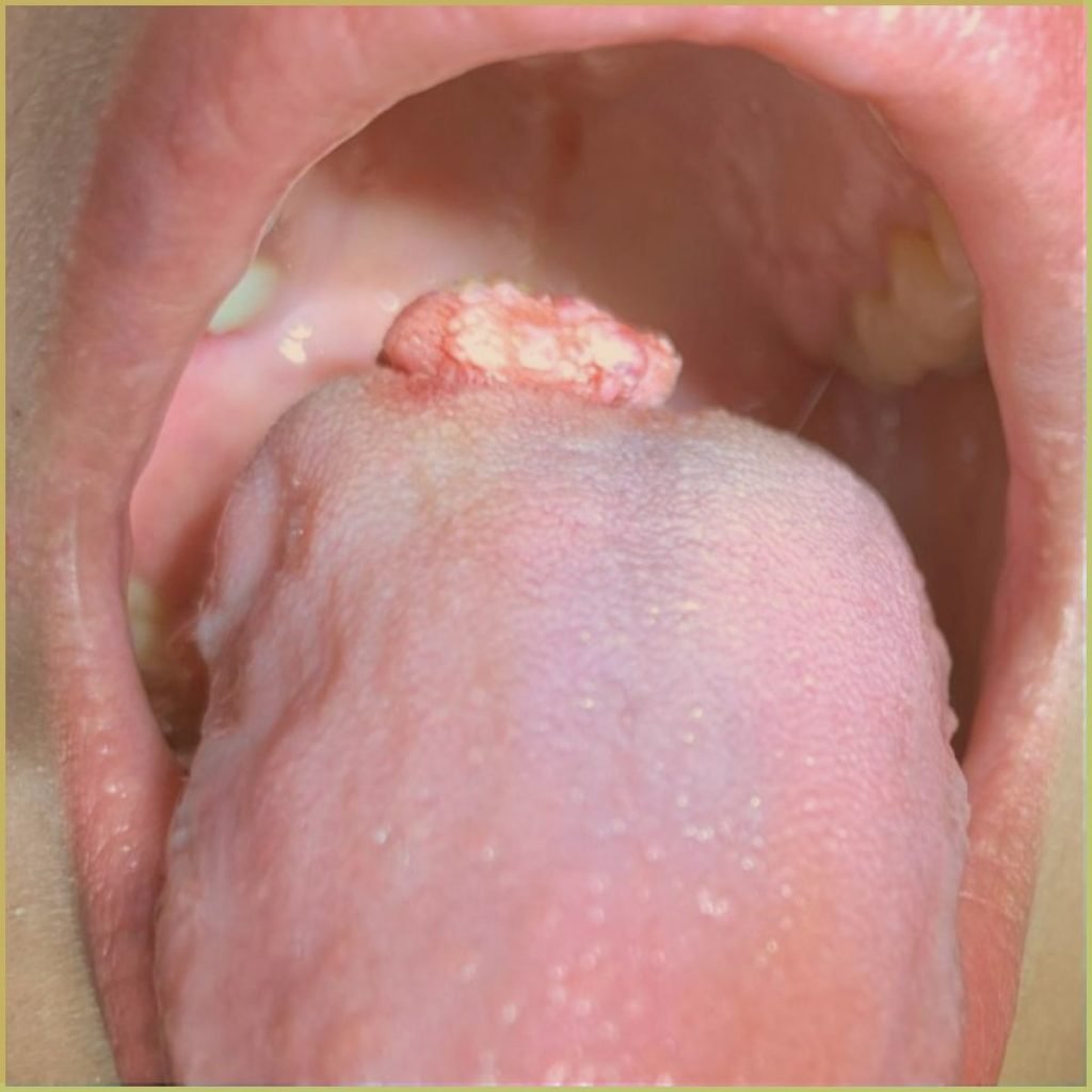 Lymphangioma 3 1024x1024 1