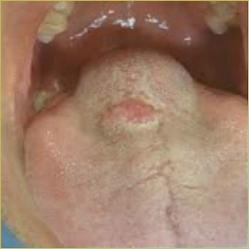 Lymphangioma 4 1024x1024 1