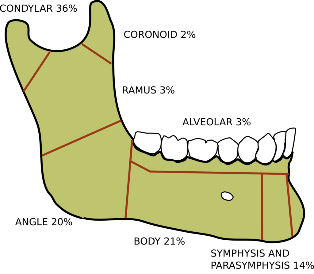 Mandibular fractures e1738071844854