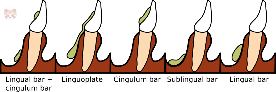 Mandibular major connectors