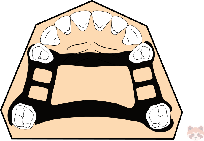 Maxillary connector Anterior posterior palatal strap