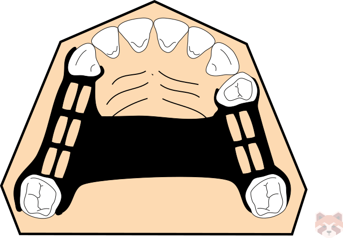 Maxillary connector Single palatal strap