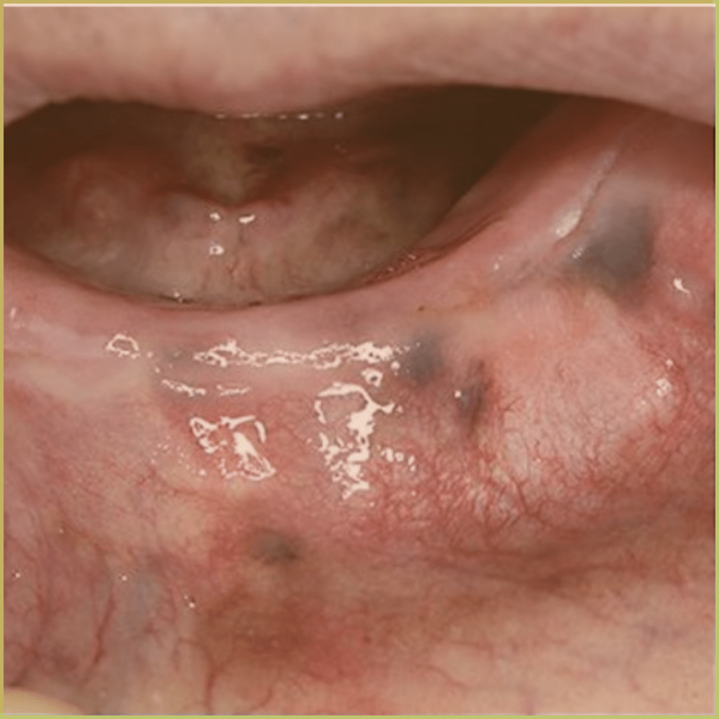 Melanoma 5 1024x1024 1